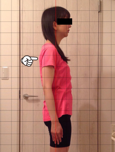 美骨整復術による改善例