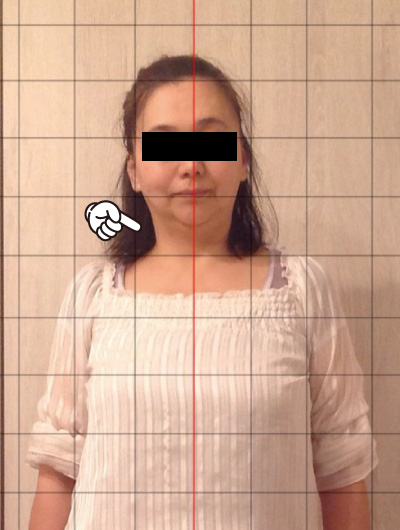 美骨整復術による改善例