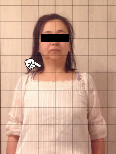 美骨整復術による改善例