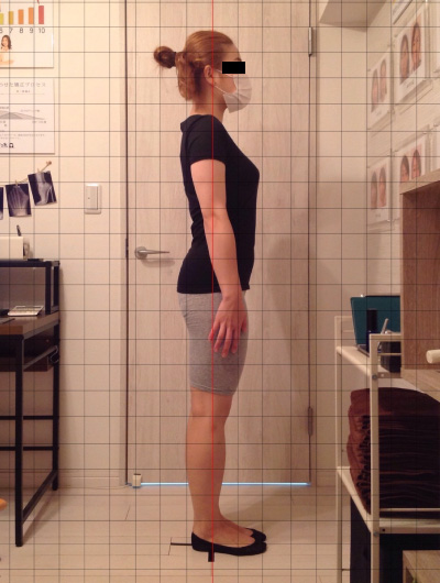 美骨整復術による改善例