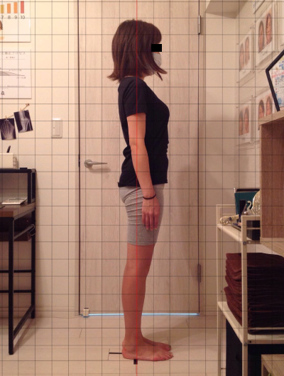 美骨整復術による改善例