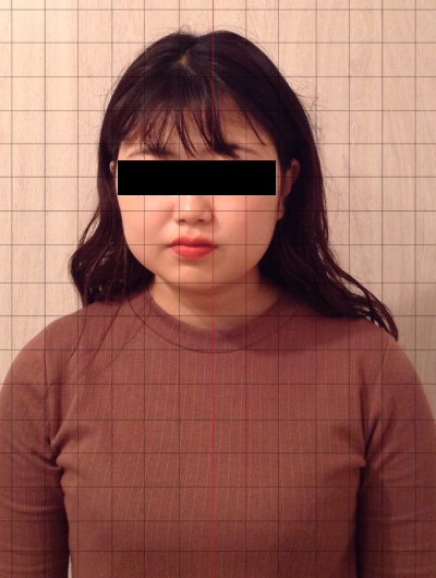 美骨整復術による改善例