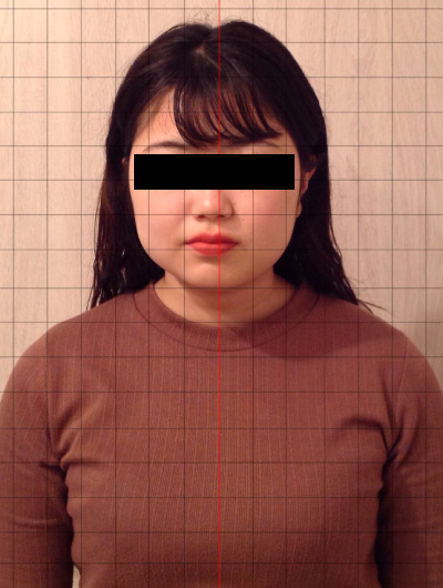 美骨整復術による改善例